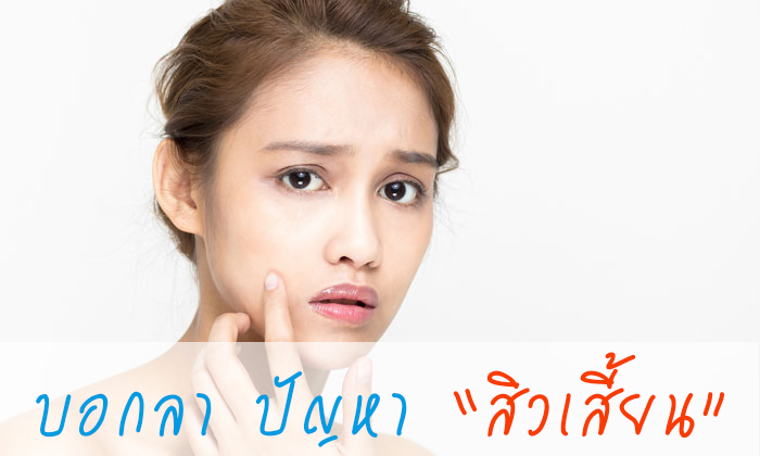 สิวเสี้ยน เจ้าปัญหา