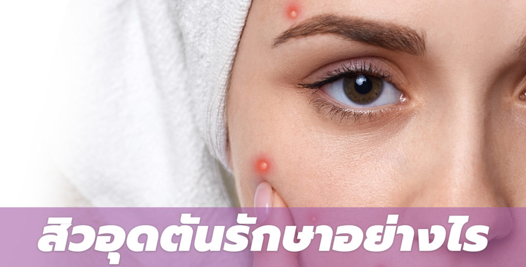 สิวอุดตัน เคล็ดลับดูแลผิวหน้า