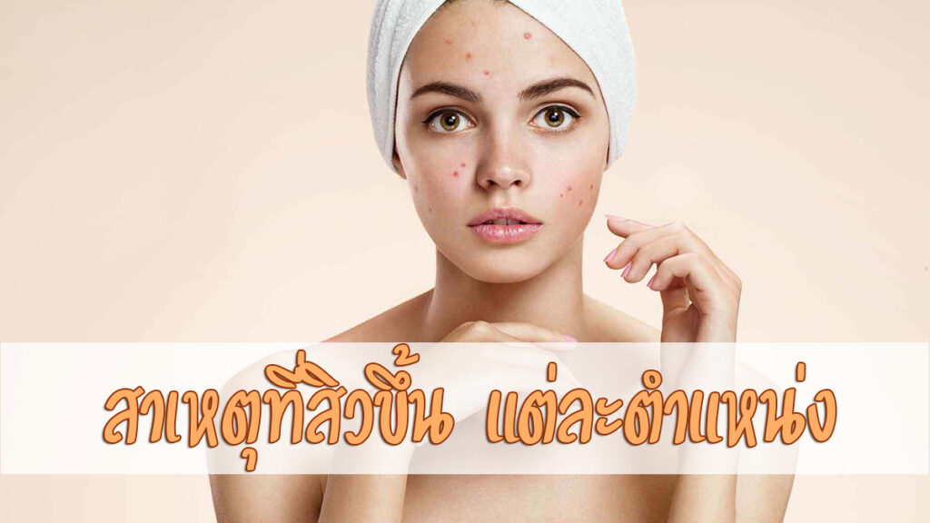 สิว บนใบหน้า