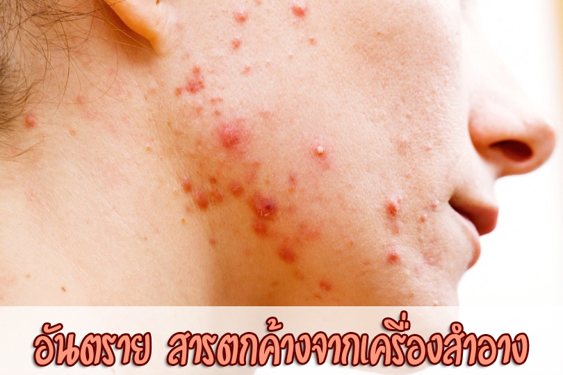 สิว กับสารตกค้าง