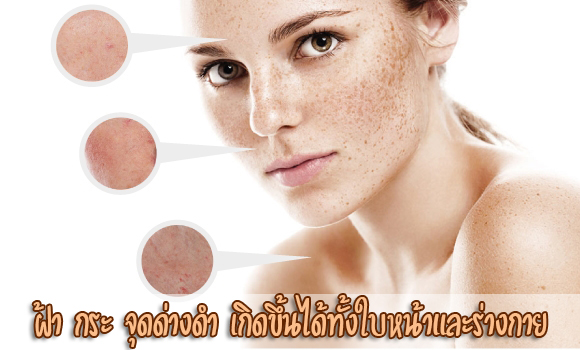 ฝ้า กระ จุดด่างดำ