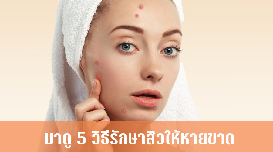 รักษาสิว ให้หายขาด