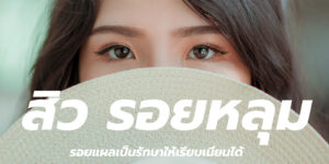 สิว รอยหลุม