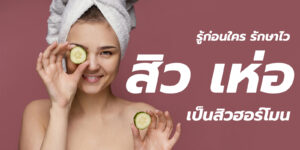 สิว เห่อ