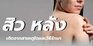 สิว หลัง