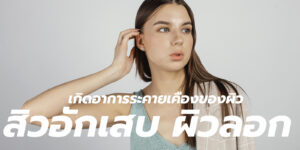 สิวอักเสบ ผิวลอก