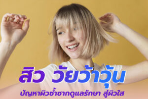 สิว วัยว้าวุ้น