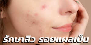 รักษาสิว รอยแผลเป็น