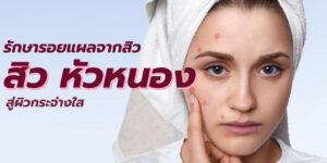 สิว หัวหนอง