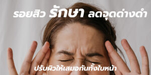 รอยสิว รักษา