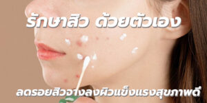 รักษาสิว ด้วยตัวเอง