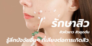 รักษาสิว รู้สึกปัจจัยอื่นๆ