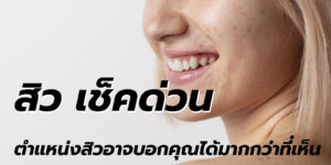 สิว เช็คด่วน
