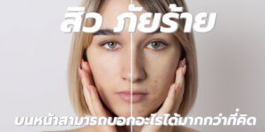 สิว ภัยร้าย