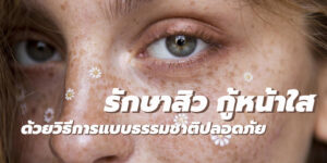 รักษาสิว กู้หน้าใส