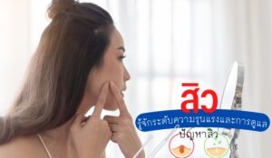 สิว รู้จักระดับความรุนแรงและการดูแล ปัญหาสิว