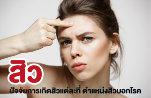 ปัจจัยการเกิดสิวแต่ละที่ ตำแหน่งสิวบอกโรค