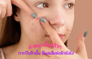 คำตอบเรื่องสิวๆ การบีบสิวนั้น มีผลเสียต่อผิวยังไง